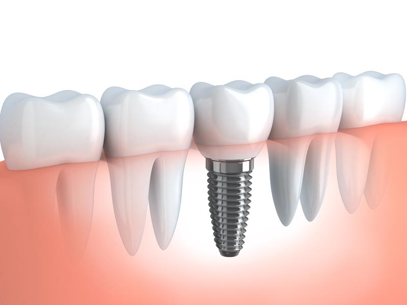 Dental Implants Brentwood, TN