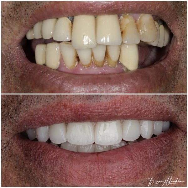 All on four dental implants cosmetic