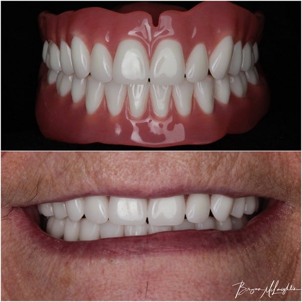 complete dentures upper plate lower plate implant dentures overdentures prosthodontist