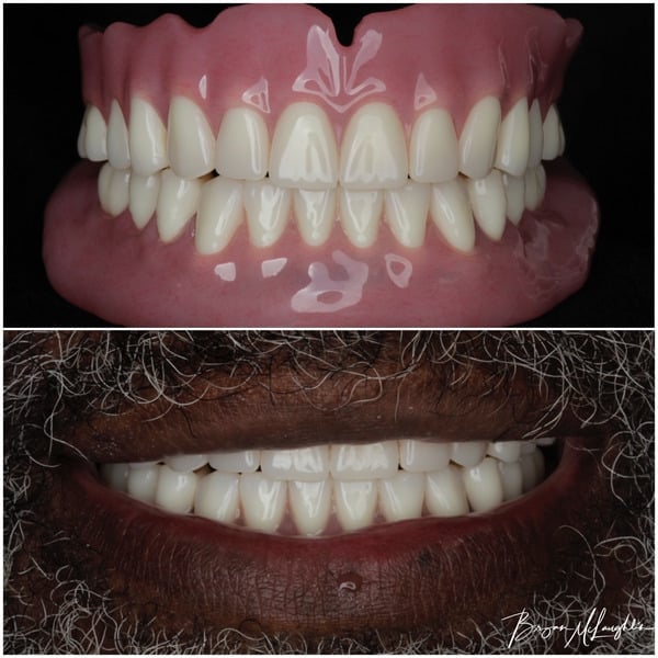 complete dentures upper plate lower plate