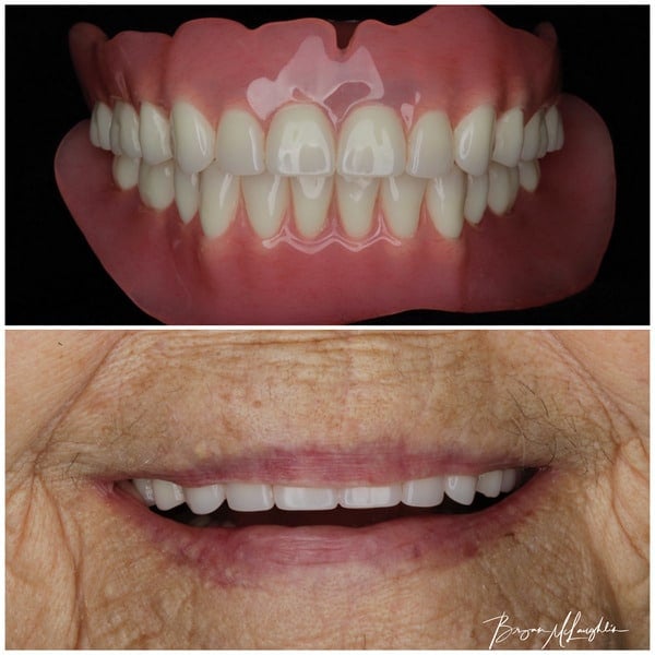 complete dentures upper plate lower