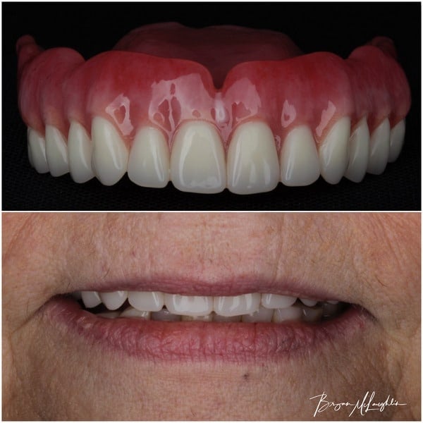 complete dentures upper plate prosthodontist