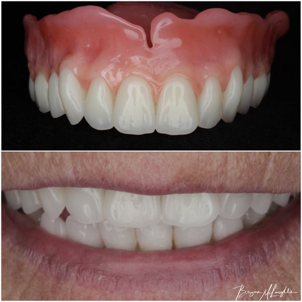 complete dentures upper plate
