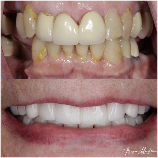 before after