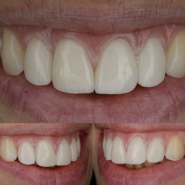 cosmetic dentistry crowns smile