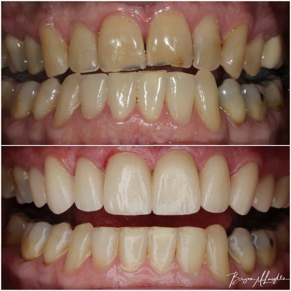 cosmetic dentistry crowns smile