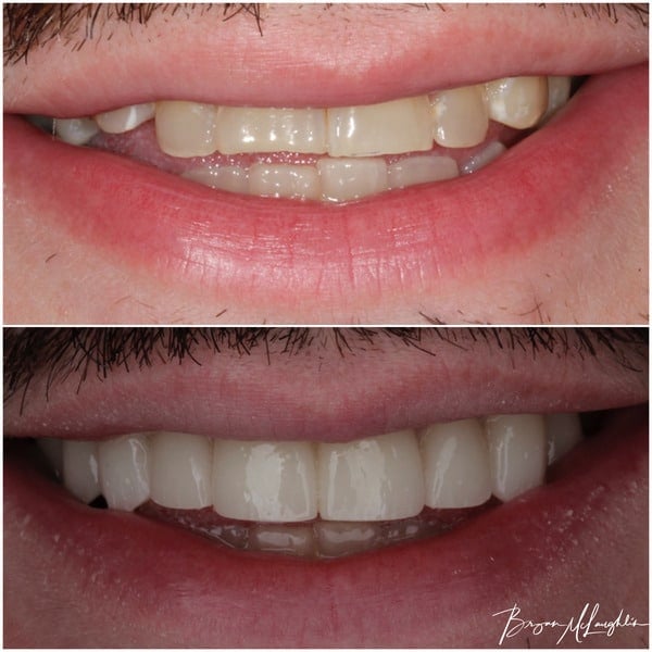 cosmetic dentistry crowns smile full mouth reconstruction