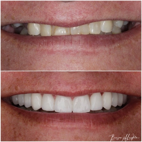 cosmetic dentistry crowns smile full mouth
