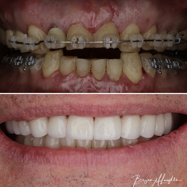 cosmetic dentistry crowns smile full mouth
