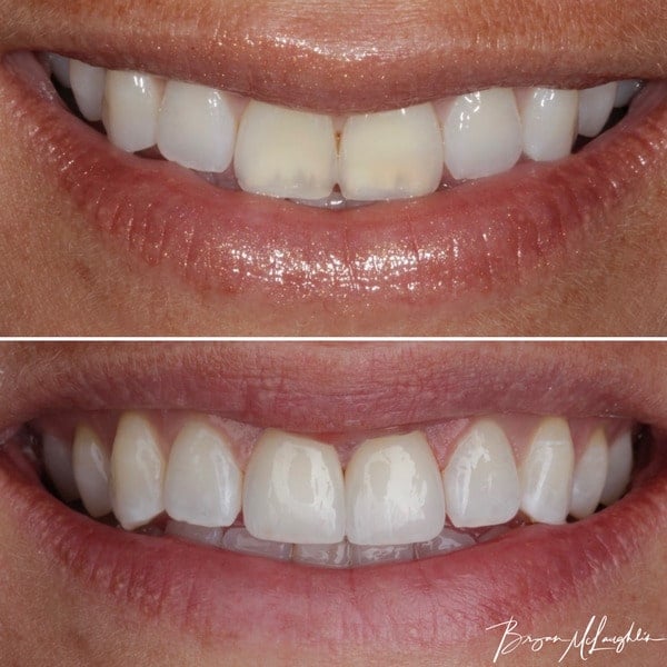 cosmetic dentistry crowns