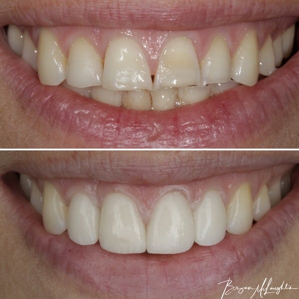 cosmetic dentistry crowns