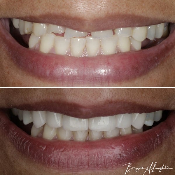 cosmetic dentistry crowns