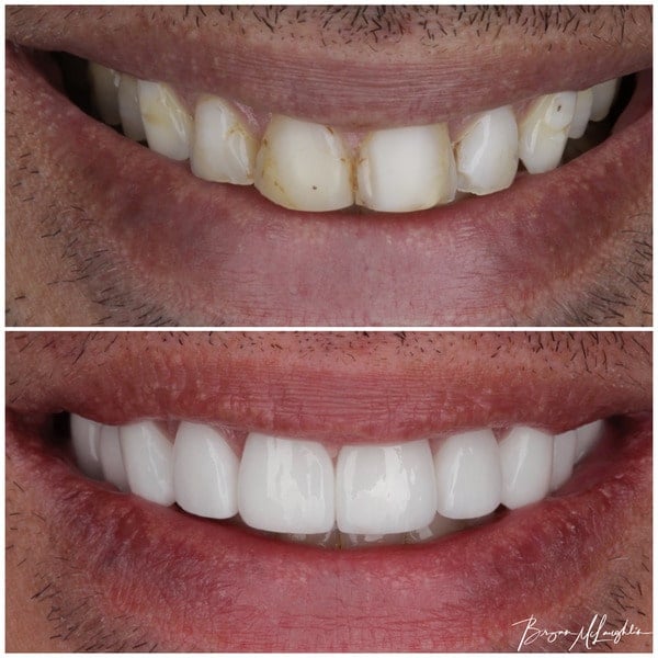 cosmetic dentistry crowns