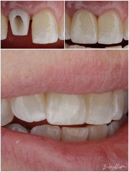 implant crown cosmetic dentistry dentist smile