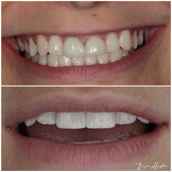 implant crown cosmetic dentistry dentist