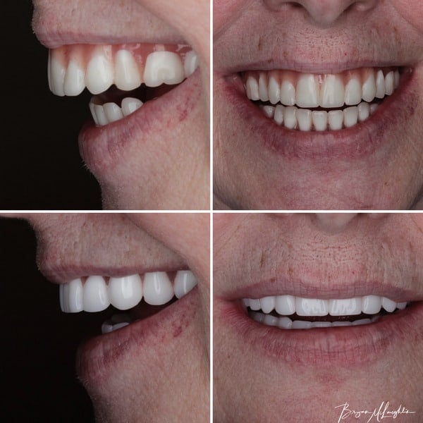 implant supported comlete dentures cosmetic