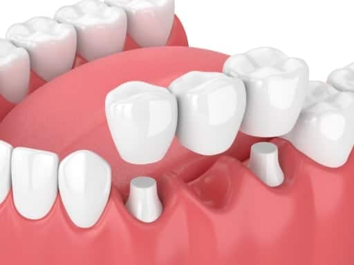 When to Choose Dental Implants Over Dental Bridges