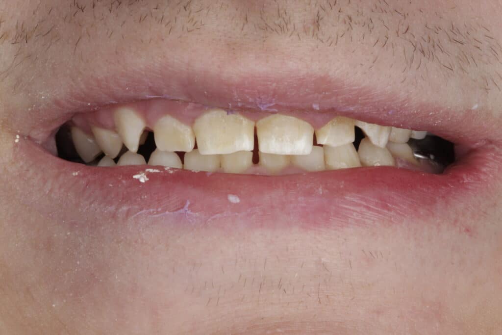 first smile before resteration